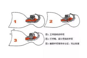 阻塞性睡眠呼吸暂停低通气综合征