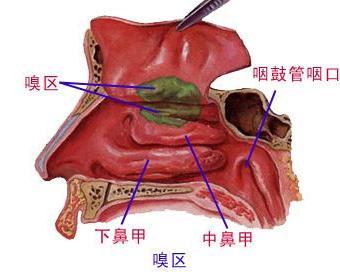 萎缩性鼻炎