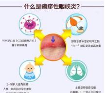 咽峡炎