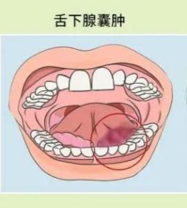 舌下腺囊肿