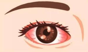 红眼病