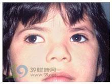 间歇性外斜视
