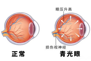 青光眼