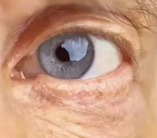 药物相关性青光眼