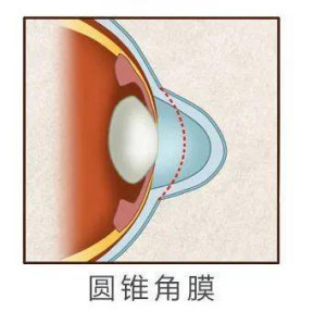 圆锥角膜