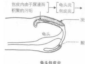 淋病性龟头包皮炎