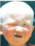 白化病