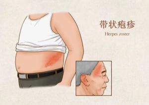 带状疱疹