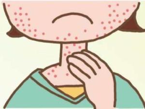 过敏