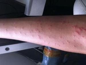 慢性荨麻疹