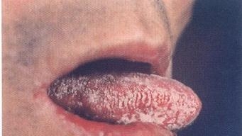 毛状白斑