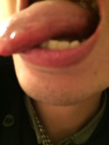 毛状白斑