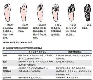 糖尿病足