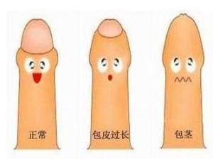 包茎