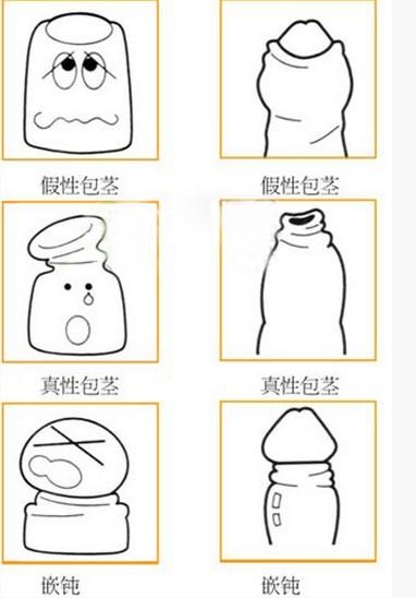 包皮过长