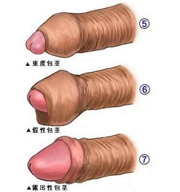 包皮过长