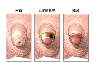 包皮过长