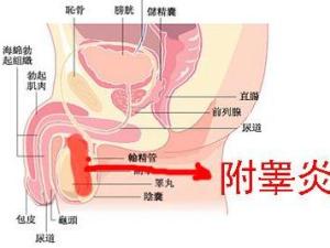 附睾炎