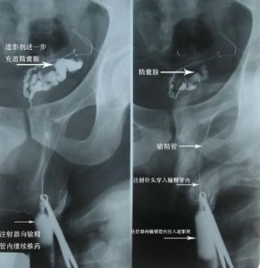 无精子症