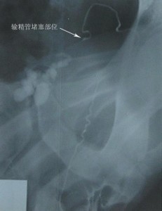 无精子症