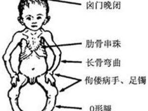 佝偻病 佝偻病