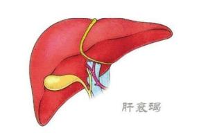 肝衰竭
