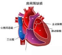 先天性心脏病