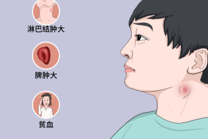 小儿自身免疫性淋巴细胞增生综合征