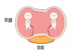 羊膜带综合征