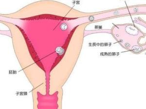 异位妊娠