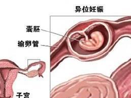 异位妊娠