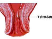 宫颈息肉
