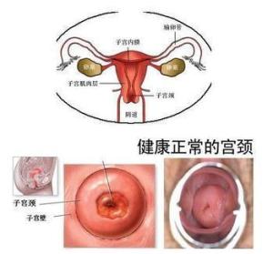 子宫颈白斑