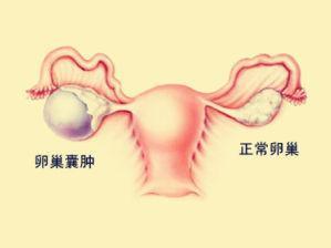 卵巢囊肿