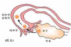盆腔炎性肿块