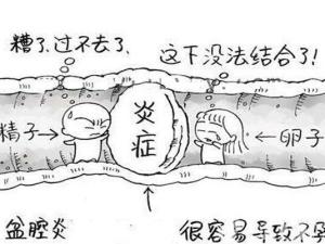 盆腔炎