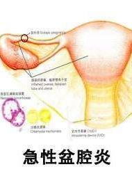 盆腔炎