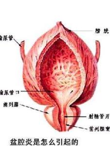 盆腔炎