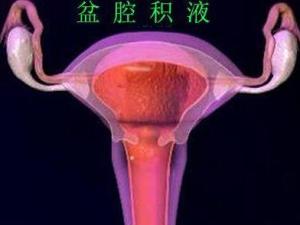 盆腔炎