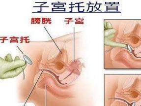 阴道后壁脱垂