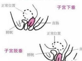 阴道后壁脱垂