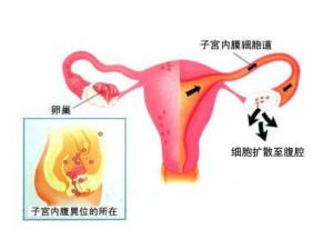 子宫内膜异位症