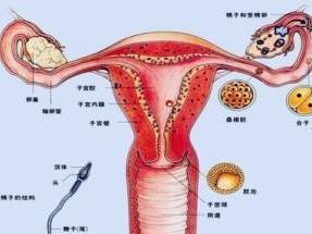 子宫内膜异位症
