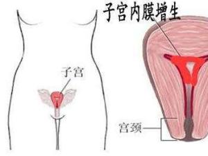 子宫内膜增生