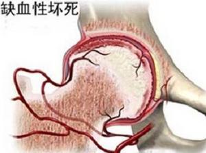股骨头缺血性坏死