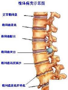 骨质增生