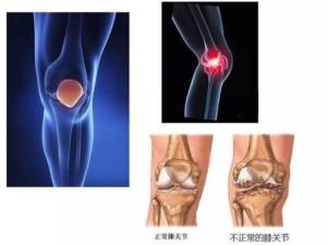 骨质增生