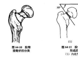 股骨颈骨折