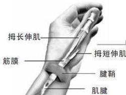 腱鞘囊肿解析图