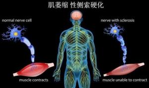 肌肉萎缩性侧索硬化症
